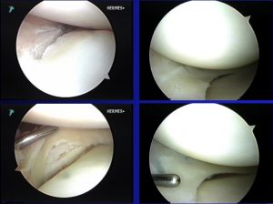 before after meniscus tear bucket handle