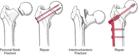 Hip Fractures and Repair